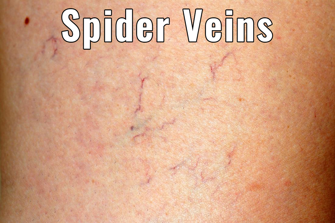 Spider Veins